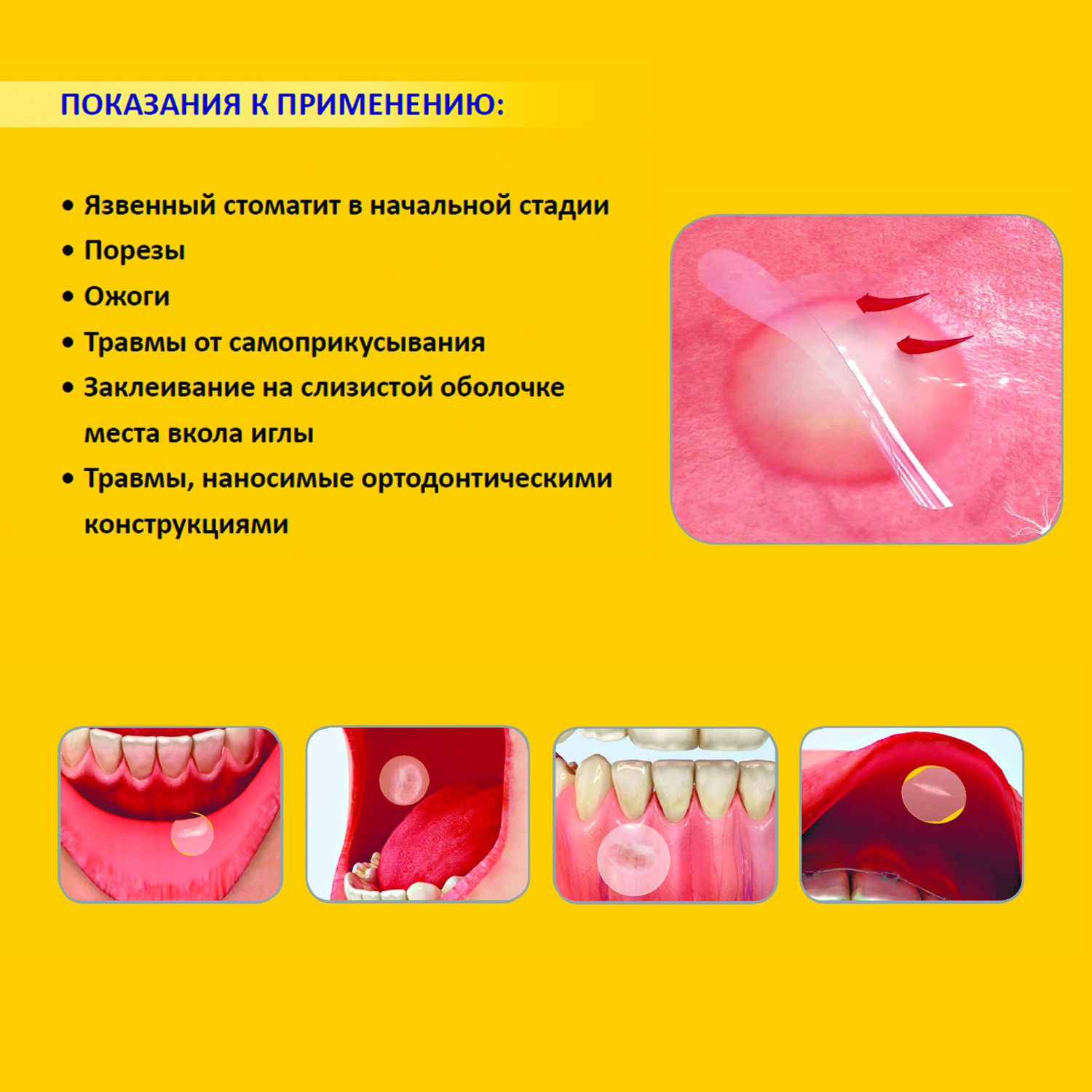 Заживляющий пластырь для слизистой рта CURATICK, 2шт/ упаковка.